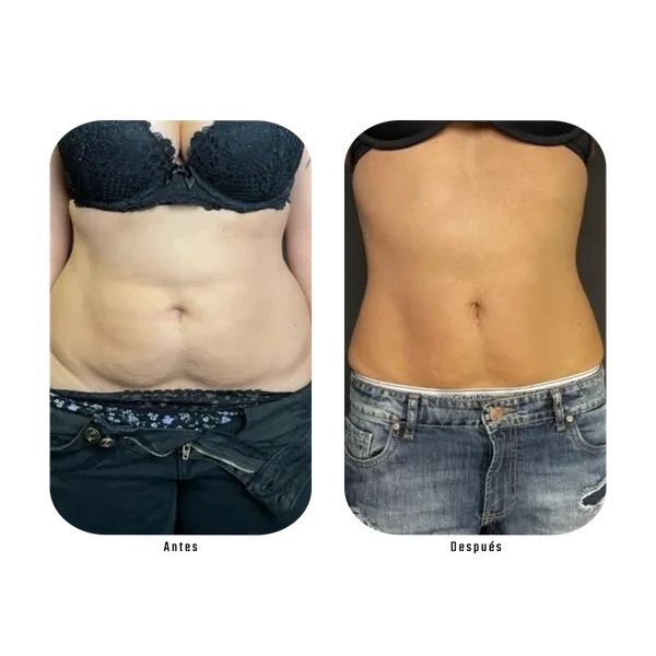 Antes y después grasa localizada abdomen y cintura — Método Hebe