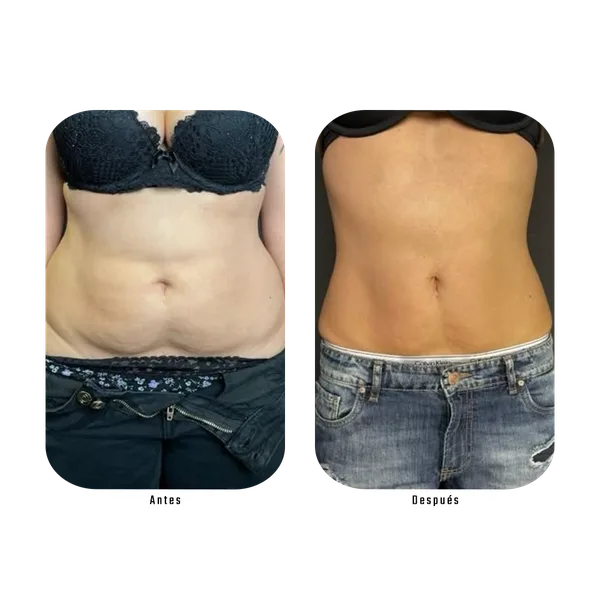 Resultado antes y después de tratamiento de abdomen y cintura con Método Hebe — reducción visible de grasa localizada