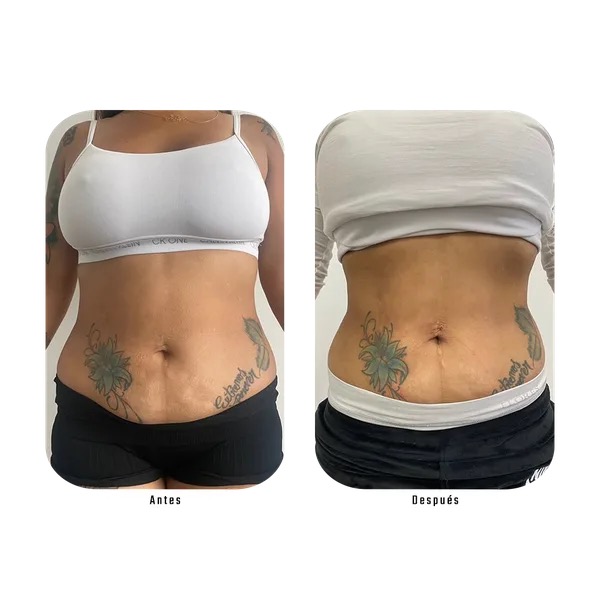 Antes y después abdominal vista frontal — Método Hebe