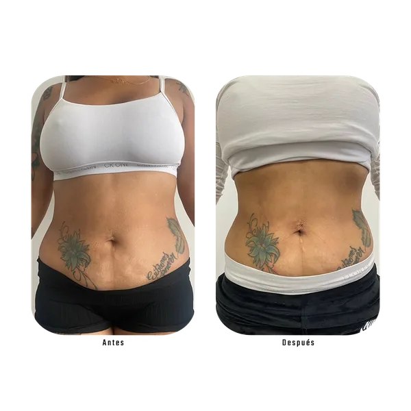 Resultado antes y después de tratamiento abdominal frontal con Método Hebe — reducción de medidas