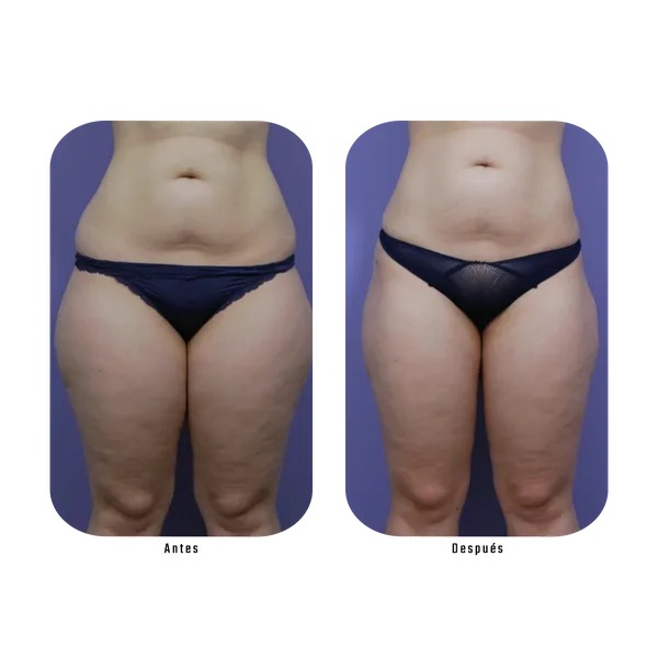 Antes y después grasa localizada abdomen y muslos — Método Hebe