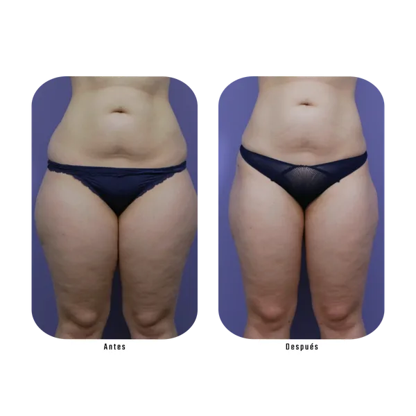 Resultado antes y después de tratamiento de abdomen y muslos con Método Hebe — reducción de celulitis y grasa