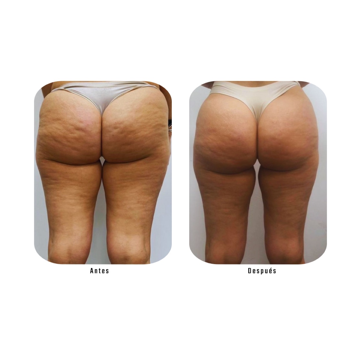 Antes y después — Reducción de celulitis en glúteos con Plan Zero Celulitis, Método Hebe