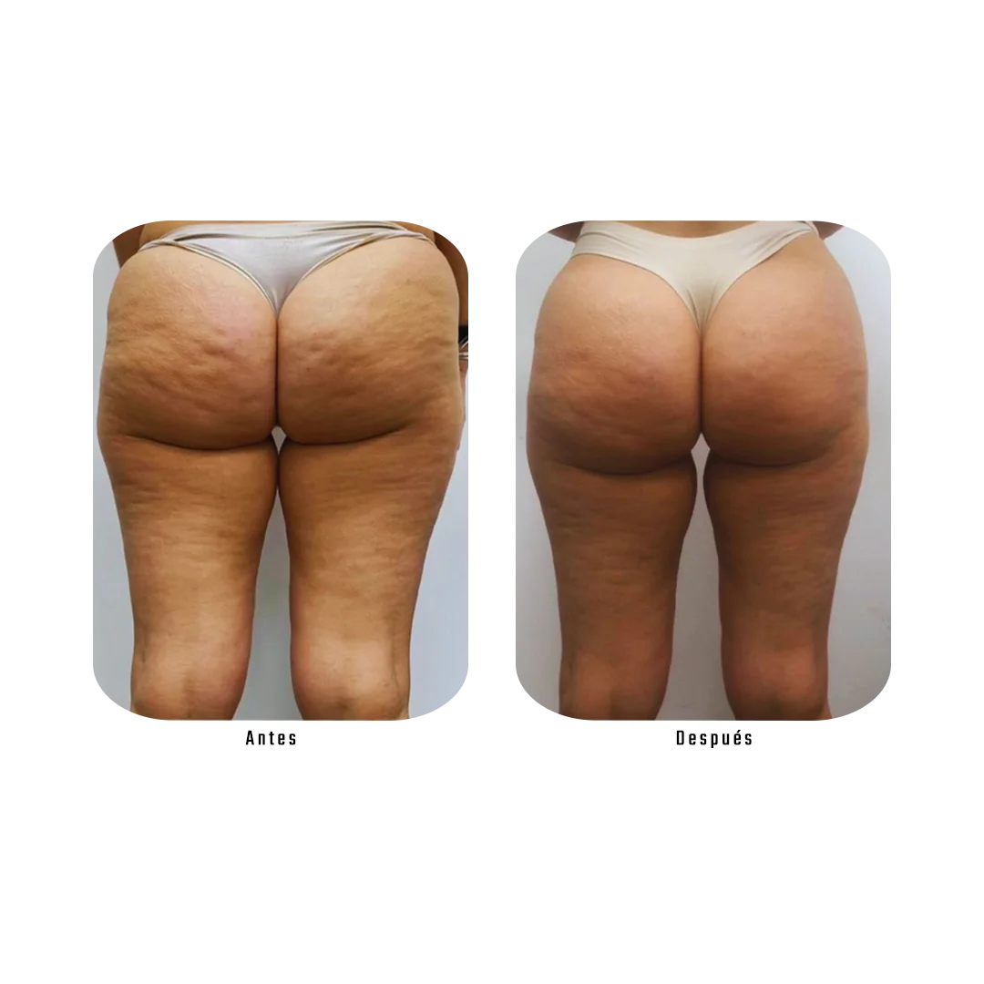 Antes y después de tratamiento de celulitis