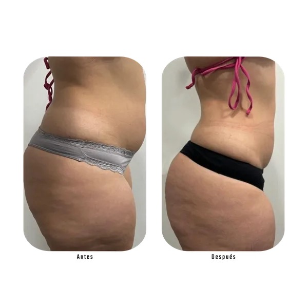 Antes y después de tratamiento para celulitis en glúteos — paciente Método Hebe