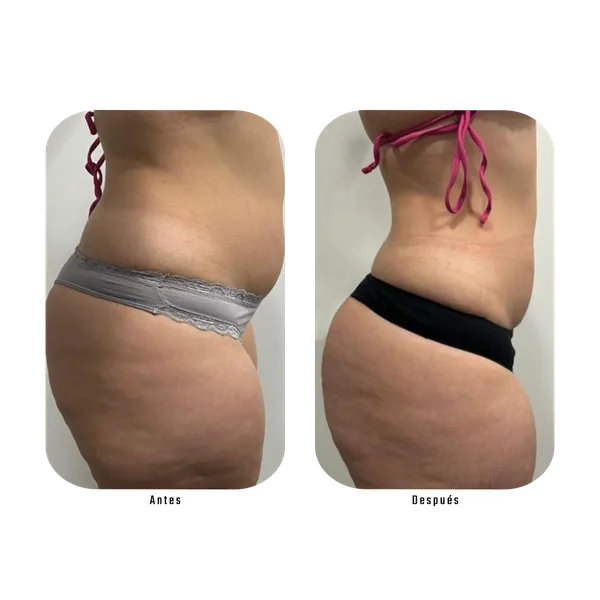 Resultado antes y después de tratamiento de celulitis en glúteos con Método Hebe — eliminación de piel de naranja