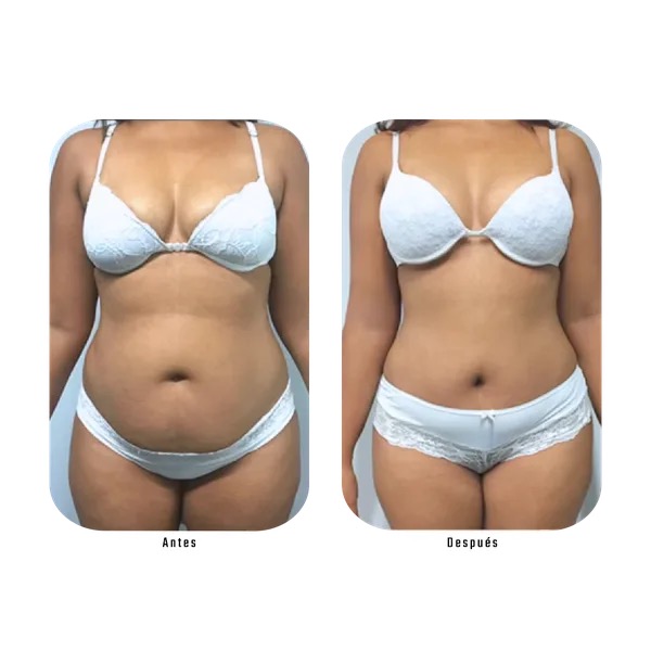 Antes y después contorno corporal — Método Hebe