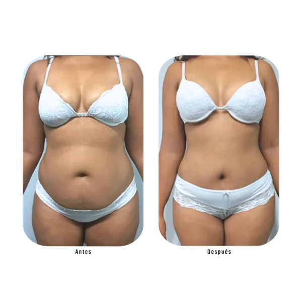 Resultado antes y después de remodelación de contorno corporal completo con Método Hebe