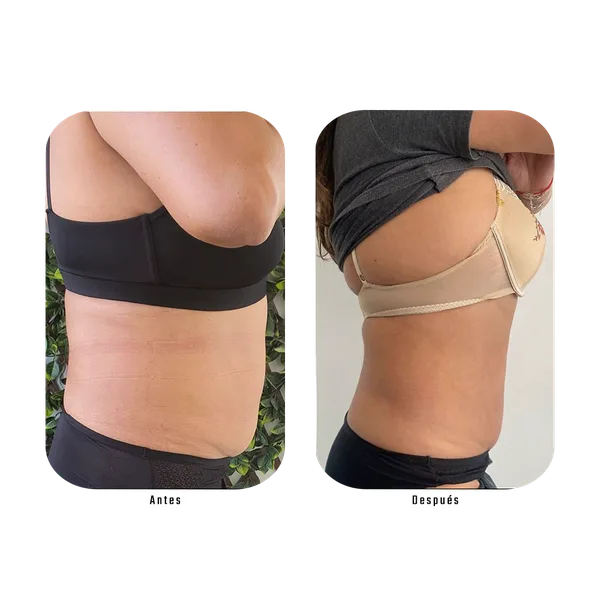 Resultado antes y después de tratamiento de espalda y lateral con Método Hebe — reducción de rollitos