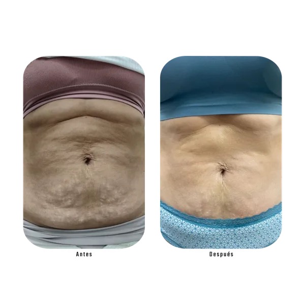 Antes y después de tratamiento para flacidez abdominal — paciente Método Hebe