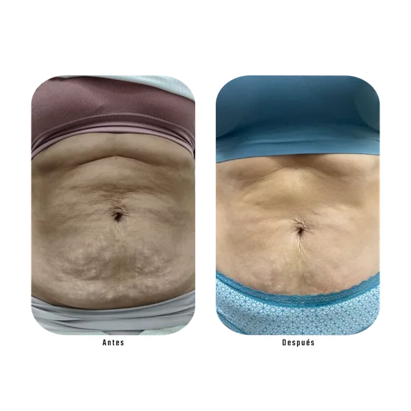 Resultado antes y después de tratamiento de flacidez abdominal con Método Hebe — piel más firme y tonificada
