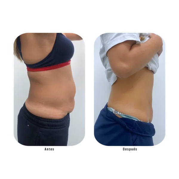Antes y después vista lateral de abdomen — Método Hebe