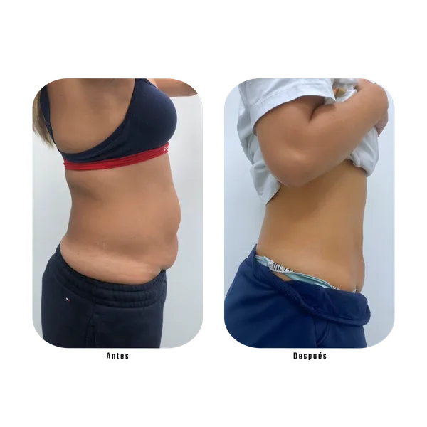 Resultado antes y después de reducción de abdomen lateral con Método Hebe — silueta redefinida