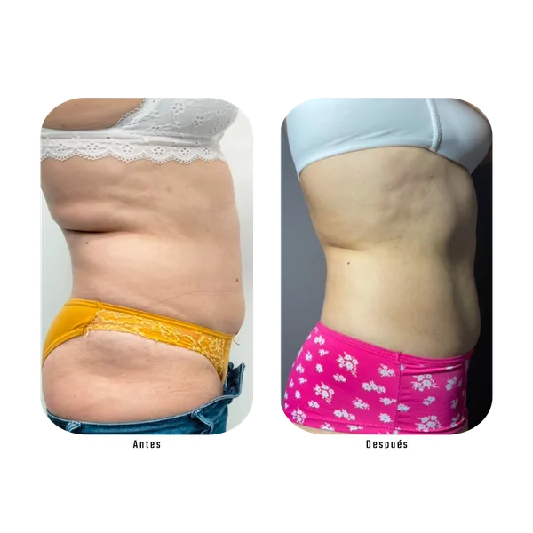 Resultado antes y después de tratamiento lateral de cintura con Método Hebe — remodelación de contorno corporal