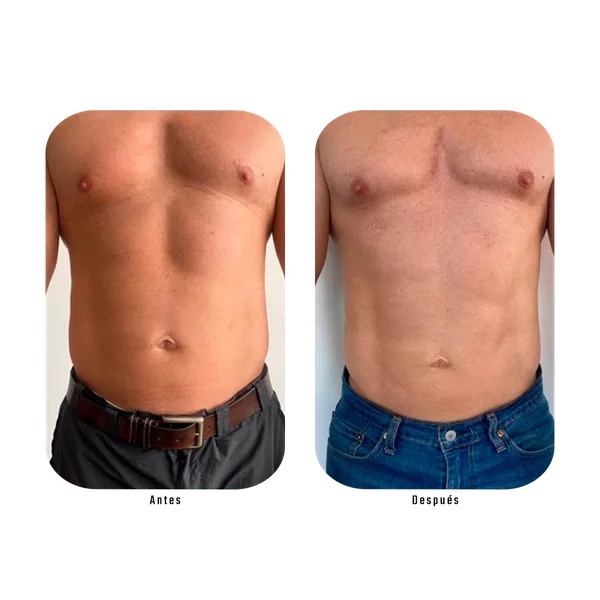 Antes y después tonificación corporal masculina — paciente Método Hebe