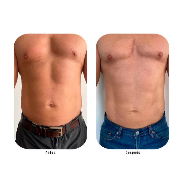 Resultado antes y después de tonificación masculina con Método Hebe — definición abdominal sin cirugía